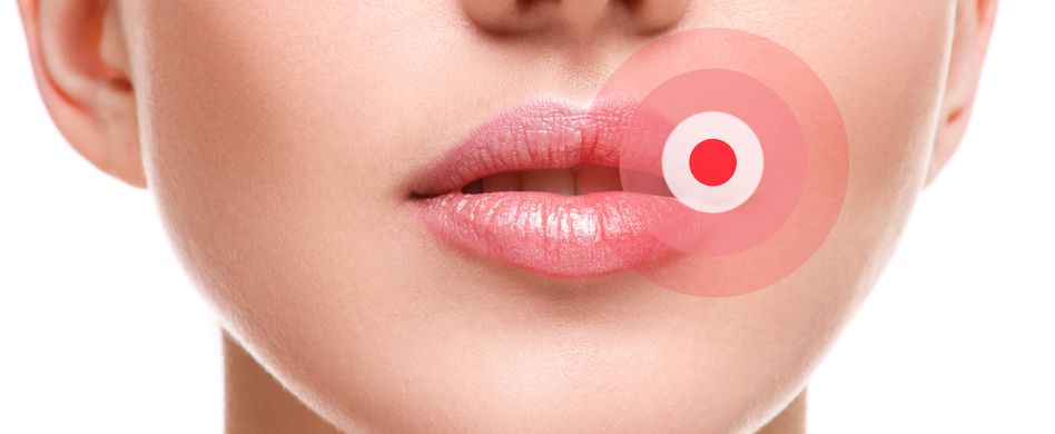 herpes oder pickel an der lippe