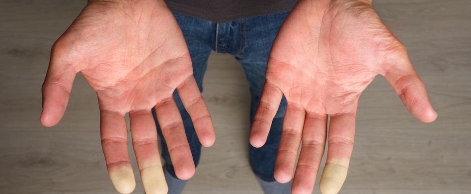 Raynaud-Syndrom: Ursachen, Symptome & Behandlung der Weißfingerkrankheit