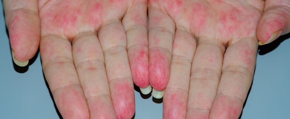 Vaskulitis: Was die chronische Entzündung der Blutgefäße für Betroffene bedeutet