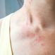 Achtung Hautpilz: 5 häufige Pilzerkrankungen des Körpers