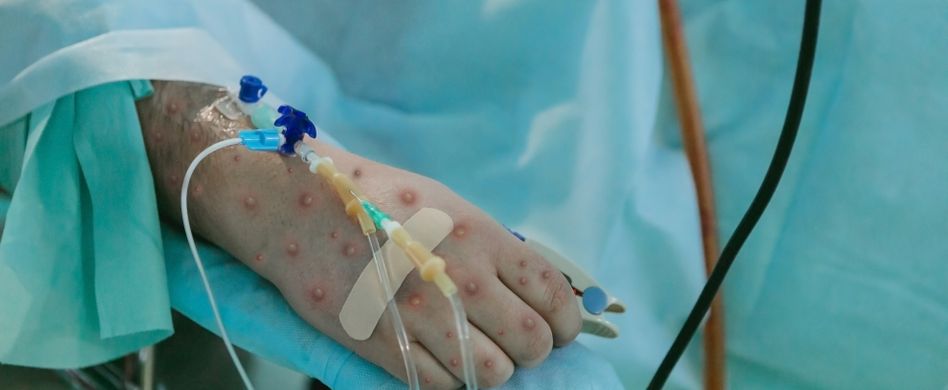 Affenpocken behandeln: die Therapie von Affenpocken