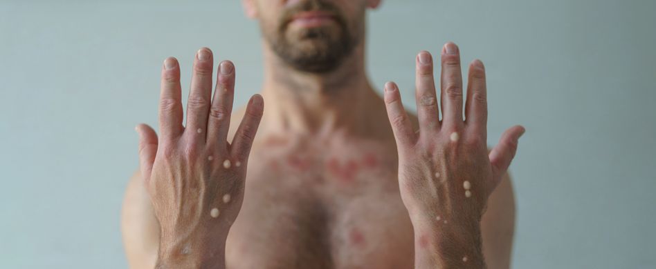 Affenpocken: Symptome der neuen Krankheit