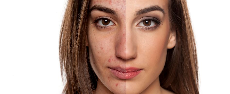 Akne: Nicht nur ein Problem junger Haut