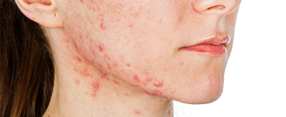 frau mit akne