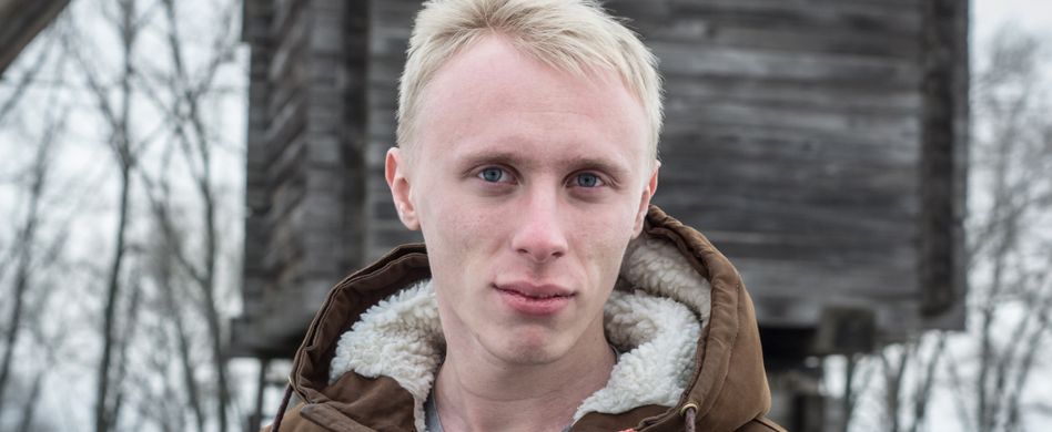 Albinismus: Ursachen und Symptome der vererbten Pigmentstörung