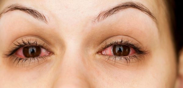 augengrippe-symptome-und-verlauf-der-virusinfektion-bild-1