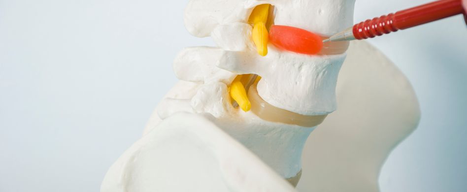 Bandscheibenvorfall: Was ist das eigentlich?