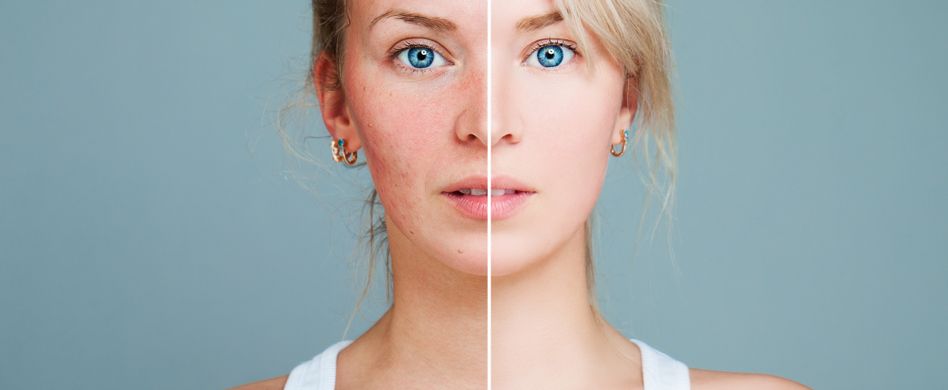 Bewältigung von Rosacea