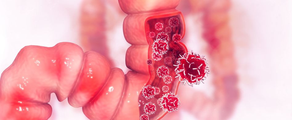 Darmspiegelung: Koloskopie erkennt Darmkrebs im Frühstadium