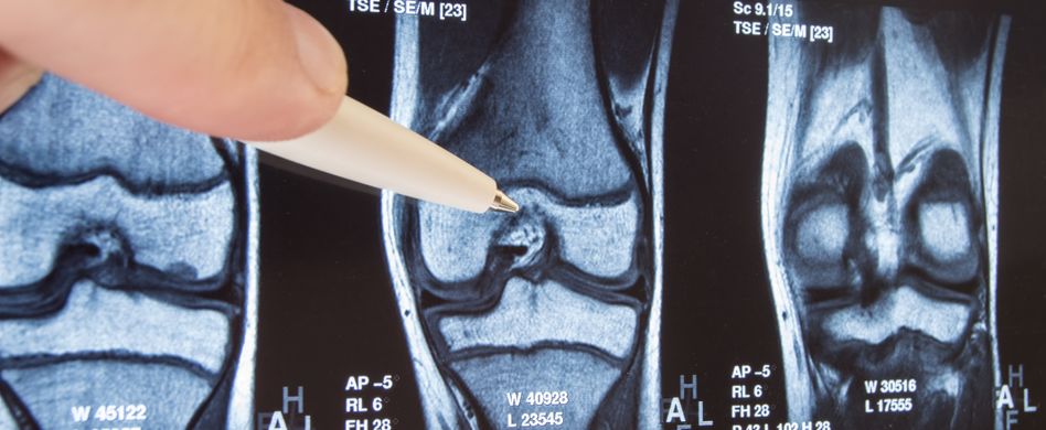 Die Ursachen von Arthrose