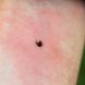 Die Verbreitung von Borreliose