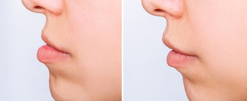 Dysgnathie-Operation: kieferchirurgische Behandlung bei Fehlstellungen