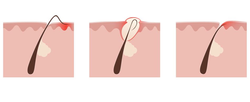 Eingewachsene Haare: Richtig entfernen und in Zukunft vermeiden