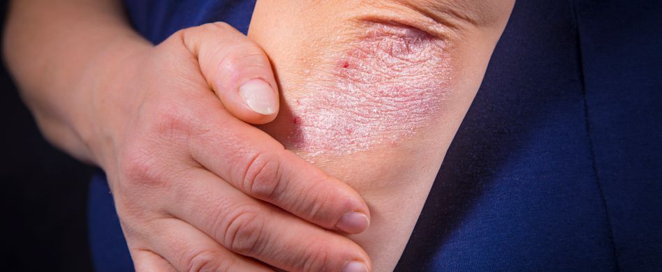 Ekzem-Symptome: So zeigt sich die Hautentzündung