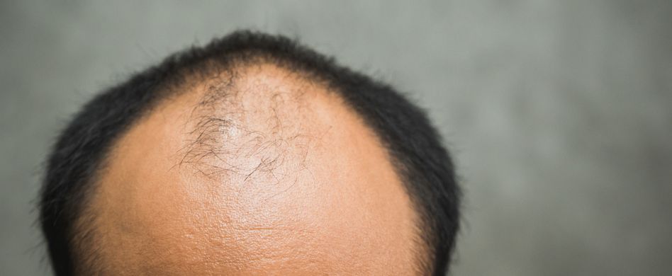 mann mit geheimratsecken