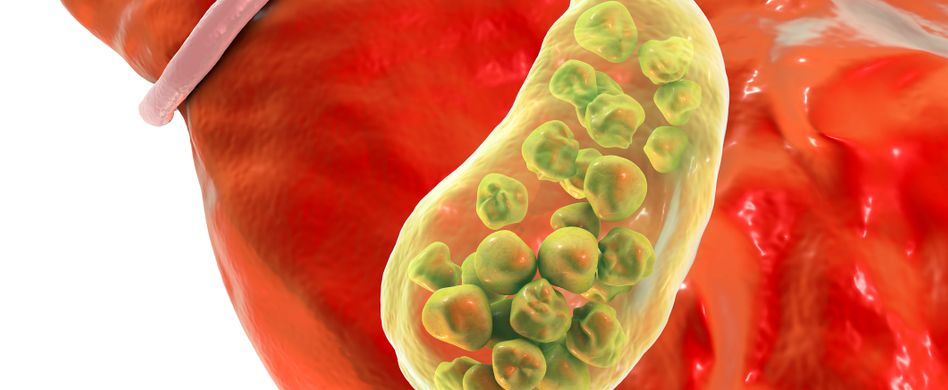 animierte aufnahme von gallensteinen