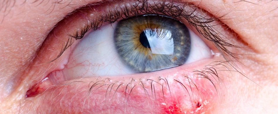 Gerstenkorn entfernen - so werden Gerstenkörner behandelt