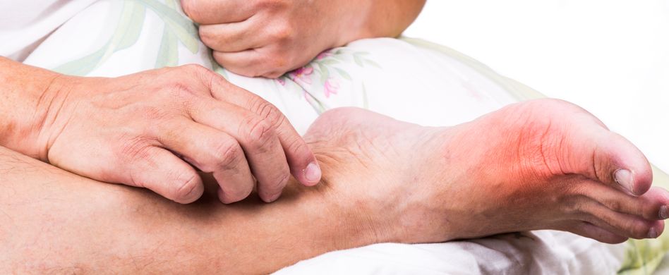 Gicht: Behandlung der Stoffwechselkrankheit