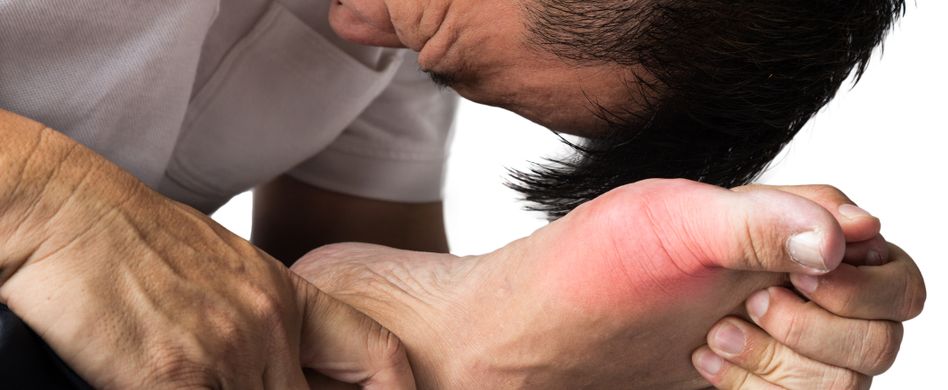 Gichtanfall: Was tun, wenn die Gelenkschmerzen zuschlagen?