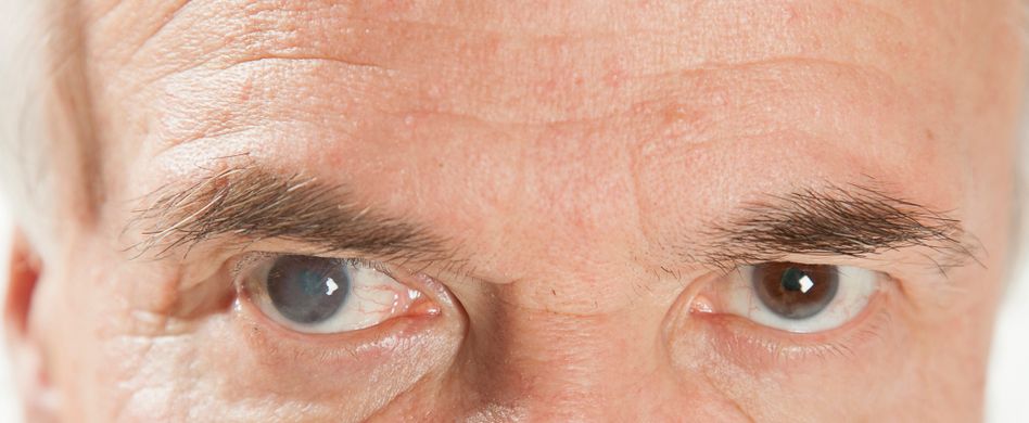 Grauer Star: Was ist das?