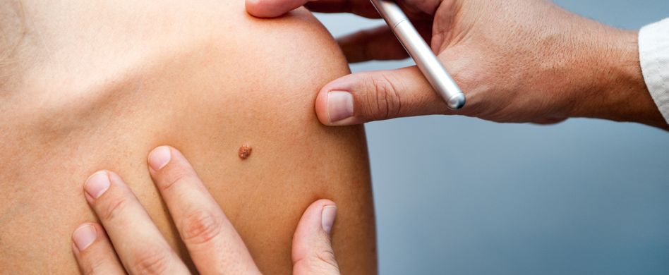 Hautkrebs erkennen: Mit der ABCDE-Regel haben Sie Ihre Haut im Blick