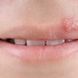 Herpes-Symptome: So zeigt sich Herpes an der Lippe