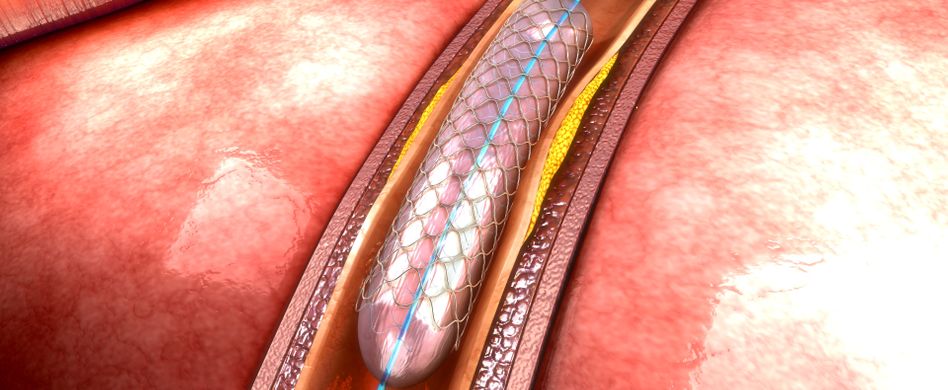 Herzinfarkt behandeln: Stent oder Bypass?