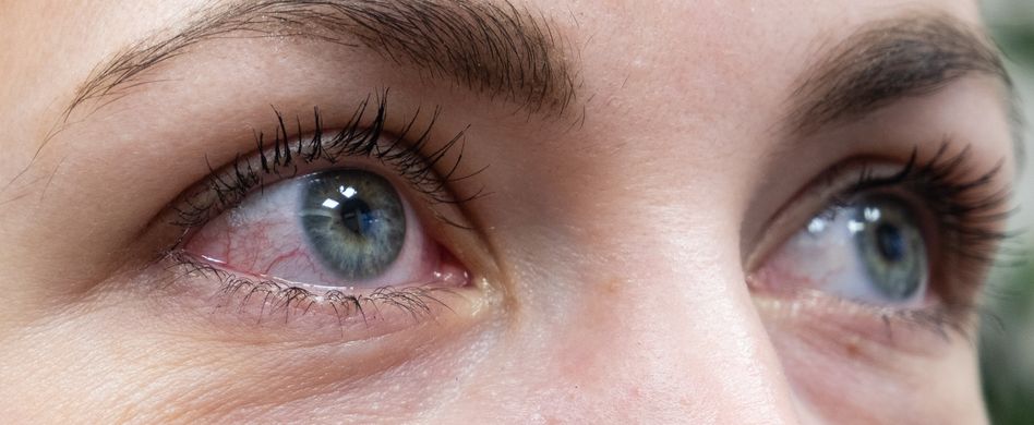Hornhautentzündung: Das sind die Symptome