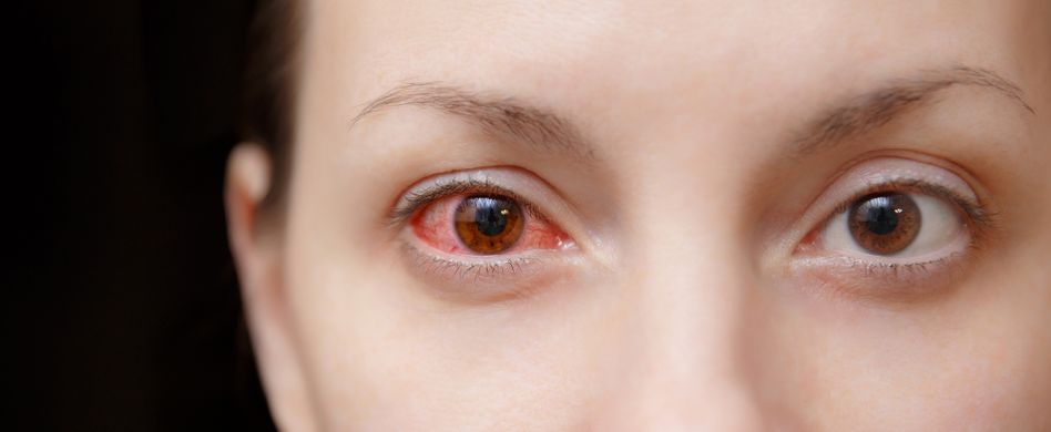 Hornhautentzündung: Was ist das?