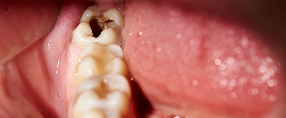 Karies vorbeugen: Das können Sie gegen Karies tun