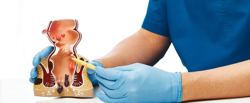 Arzt mit Modell Hämorrhoiden