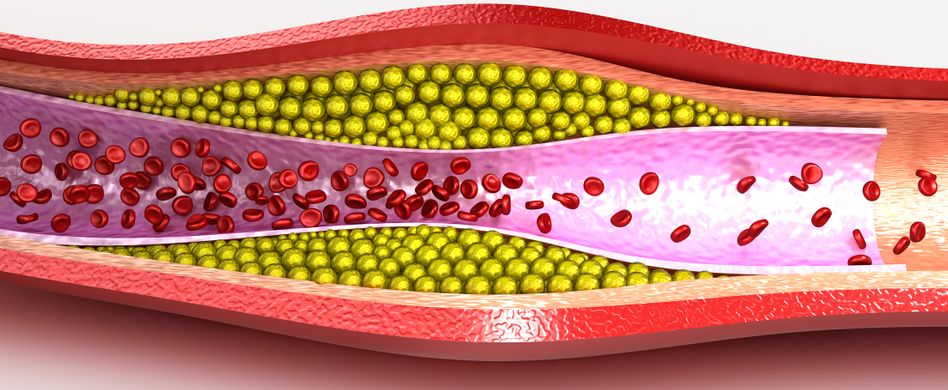 Koronare Herzkrankheit (KHK) bringt den Herzinfarkt