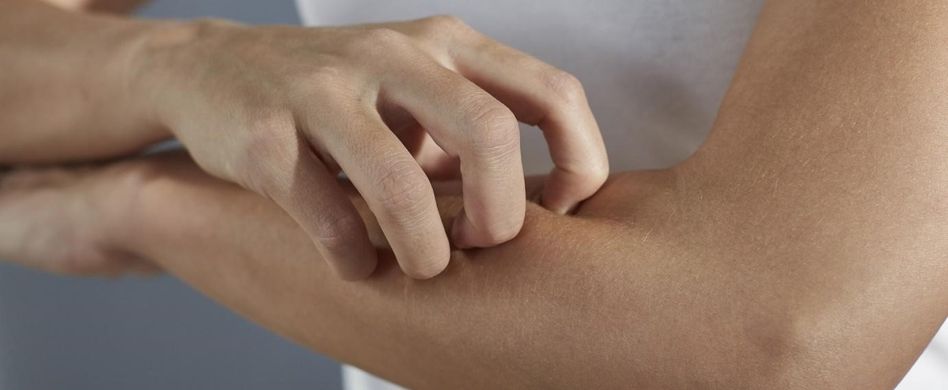 Krätze: Das kann die Ursache sein