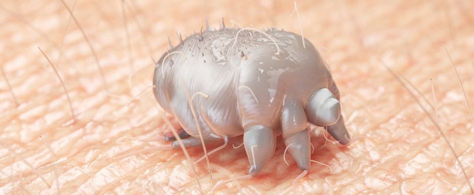 Krätze: Symptome und Übertragung der Hautkrankheit