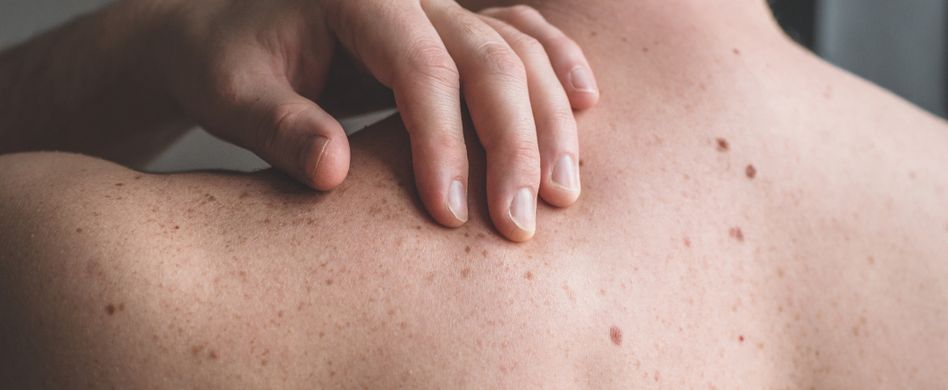 Leberfleck: Was ist das?