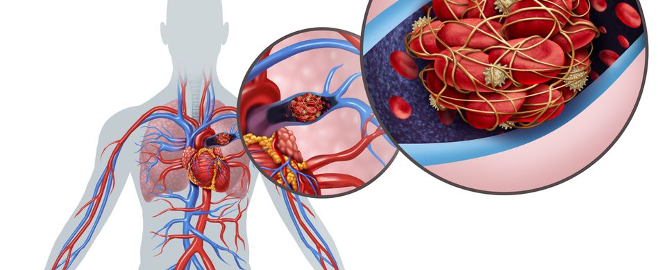 Grafik Lungenembolie