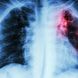 Lungenfellentzündung (Pleuritis): Ursachen, Symptome und Behandlung