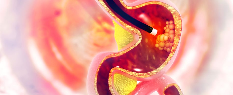 Magenkrebs-Vorsorge: Symptome und Warnzeichen erkennen