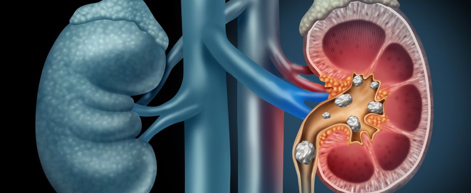 3d animation von nierensteine in niere