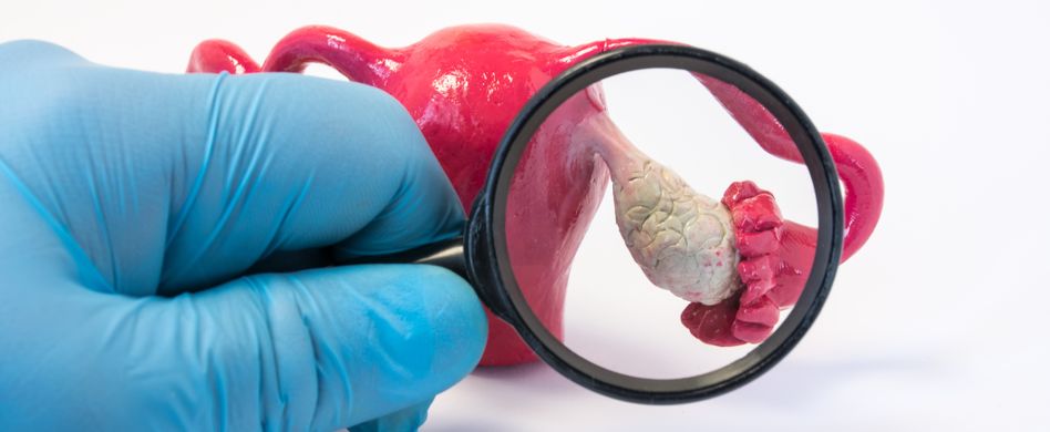 Untersuchung Modell Eierstöcke PCOS