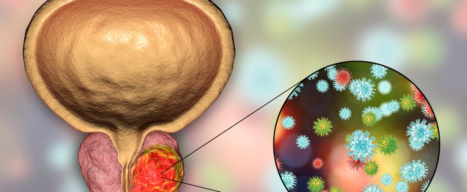 PSA-Test beim Urologen: Gibt er Hinweise auf Prostatakrebs?