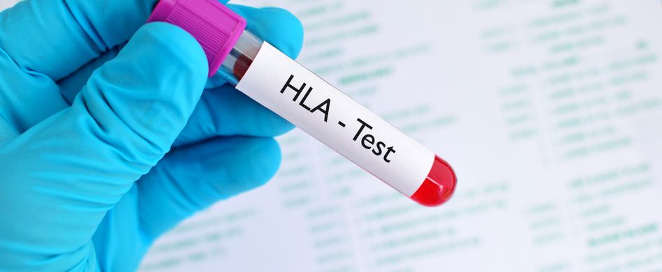 Rheumatoide Arthritis: Ursachen der chronischen Polyarthritis