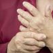 Rheumatoide Arthritis: Welche Symptome hat man bei Arthritis?