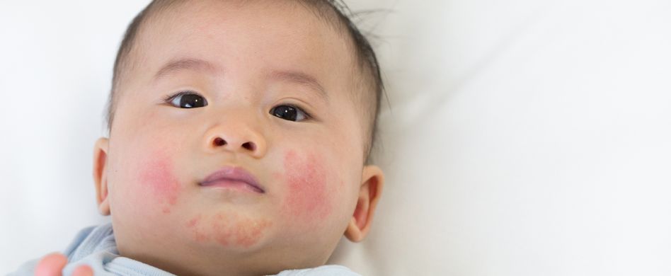 Ringelröteln erkennen: Darauf sollten Sie achten