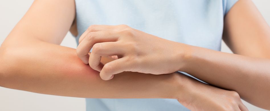 Rötung, Knötchen und starker Juckreiz: Die Symptome der Sonnenallergie