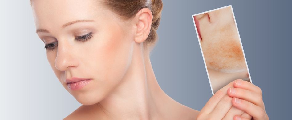 Rosazea behandeln: Entzündung im Gesicht lindern