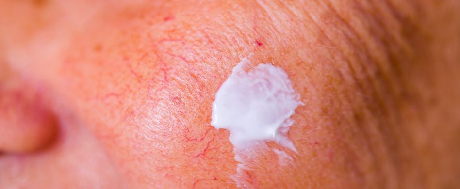 Rosazea vorbeugen: Entzündungen im Gesicht verringern