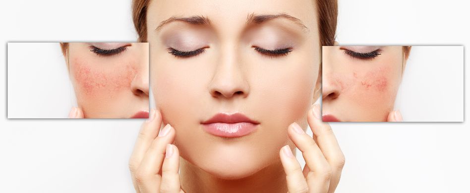 Rosazea: Was ist das?