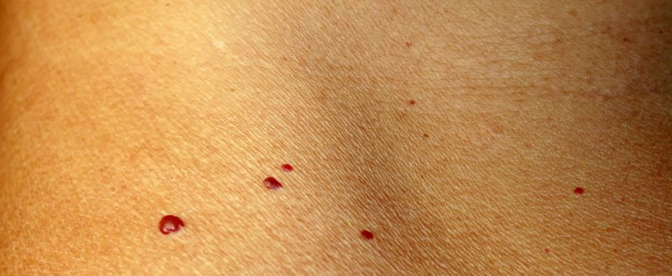 Rote Muttermale: Sind die Flecken gefährlich?