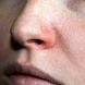 Rote Nase: Ursache für Couperose